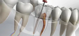 مراحل عصب کشی دندان (درمان ریشه) و هزینه‌های آن