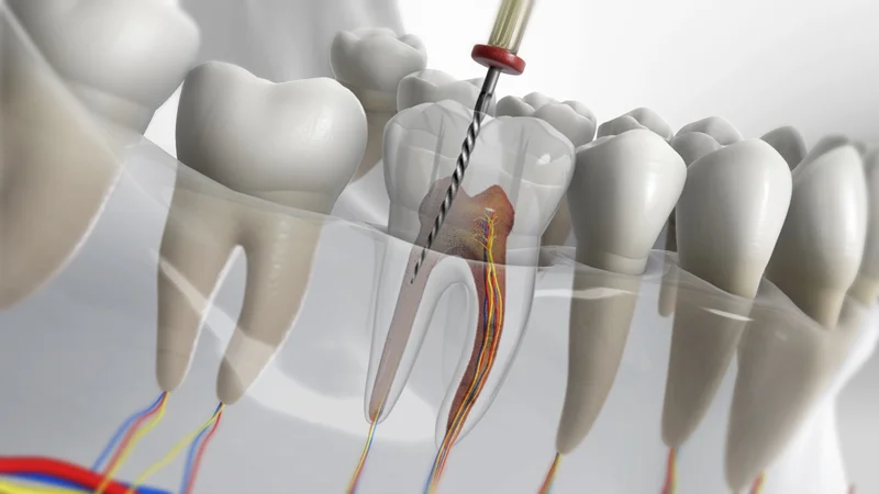 مراحل عصب کشی دندان (درمان ریشه) و هزینه‌های آن