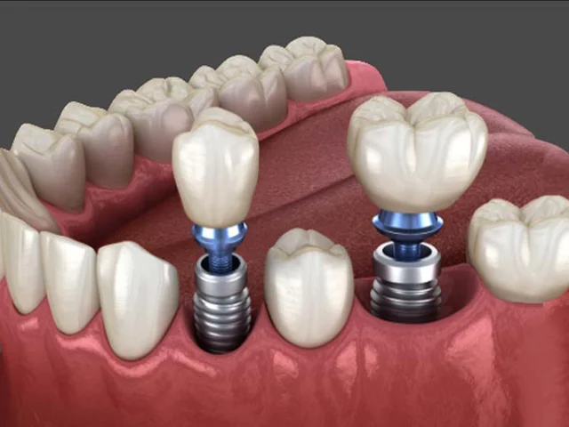 آیا ایمپلنت دندان برای همه مناسب است؟