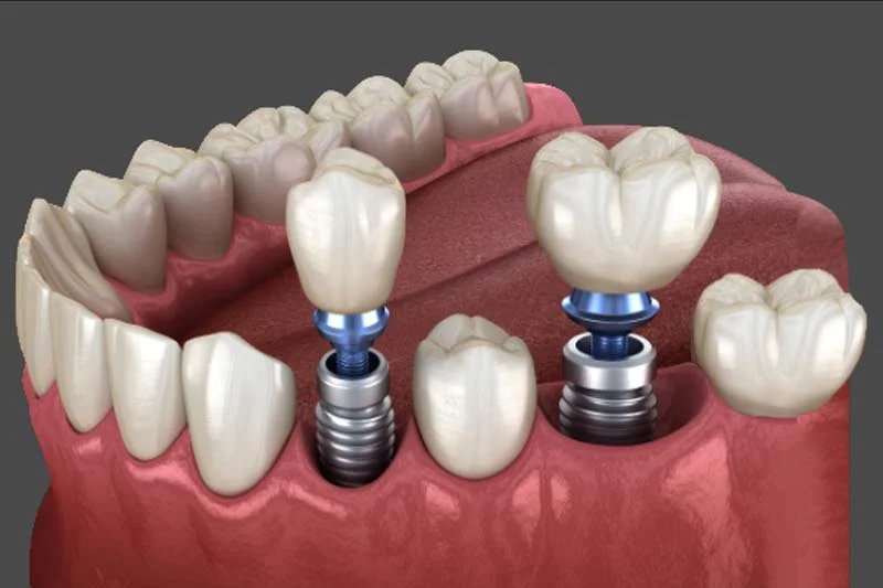 آیا ایمپلنت دندان برای همه مناسب است؟